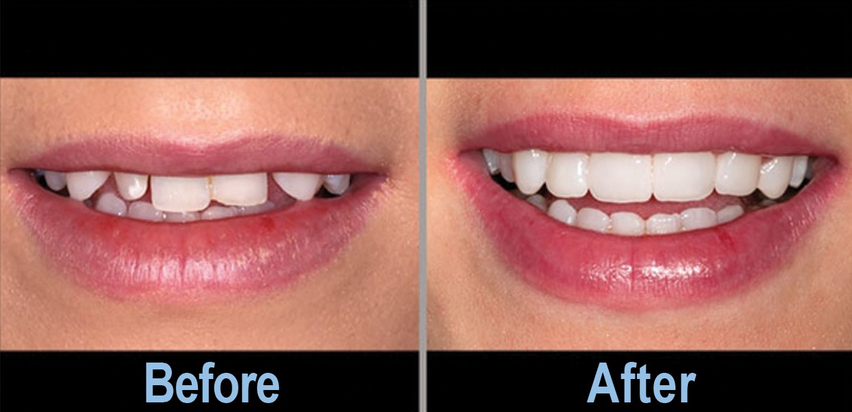 تاثیر کامپوزیت روی زیبایی چهره